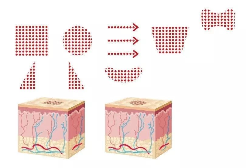 点阵激光每次间隔时间大有效果吗,点阵激光真实经历