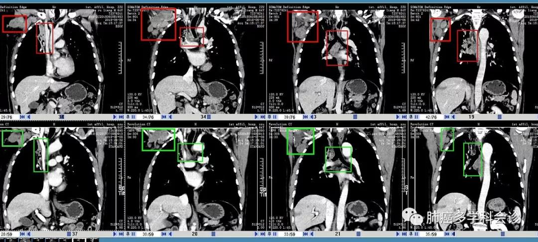 aacr肺癌高发,小细胞肺癌abc临床试验