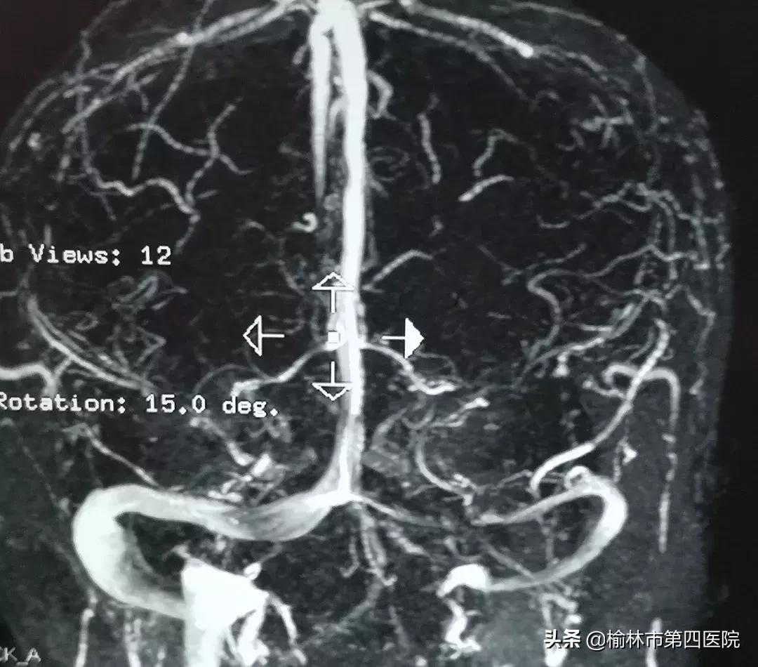 成功开展内瘘狭窄球囊扩张术,静脉窦狭窄手术