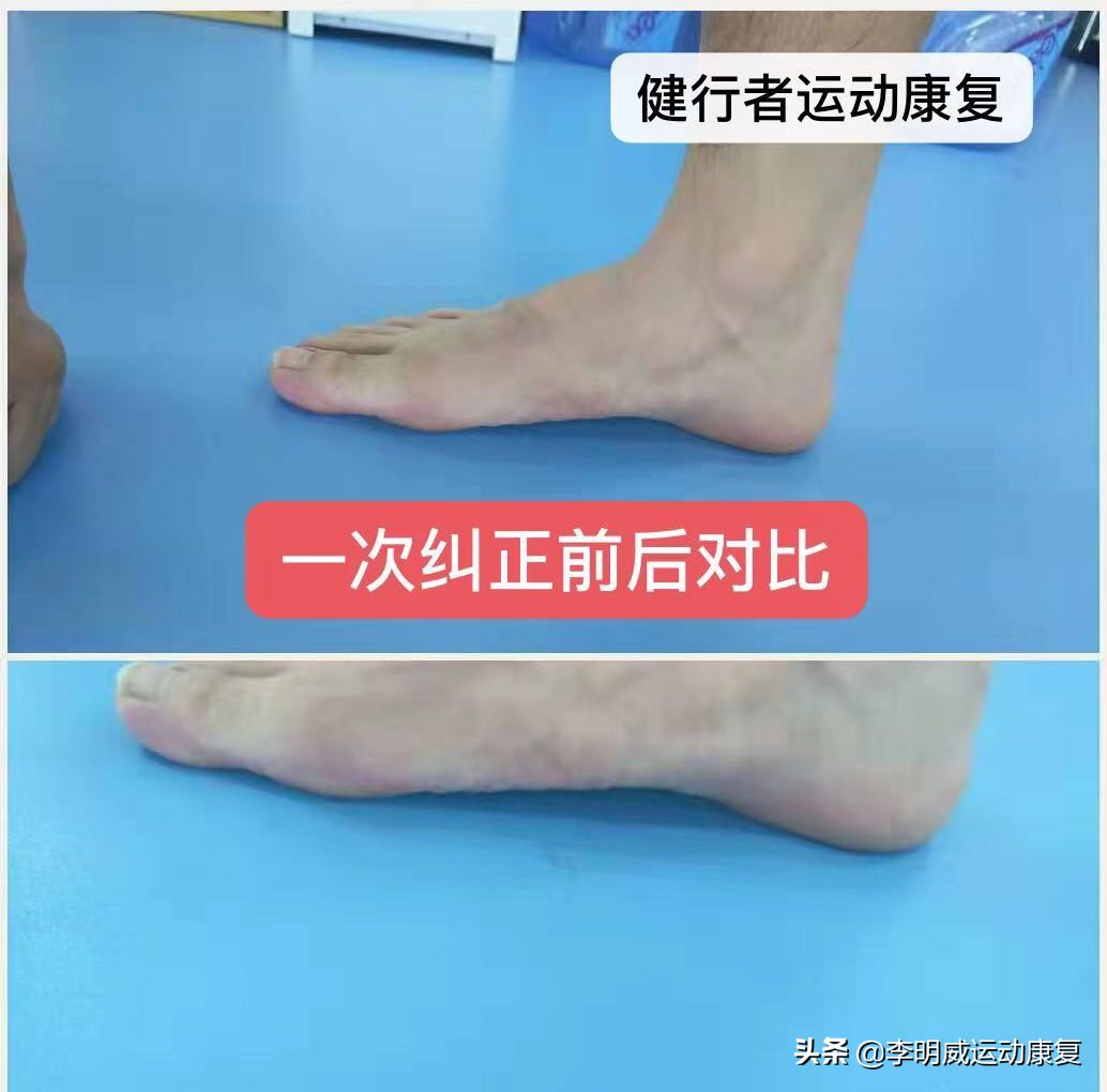 骨盆不正导致腿不直,骨盆不正导致的长短腿症状