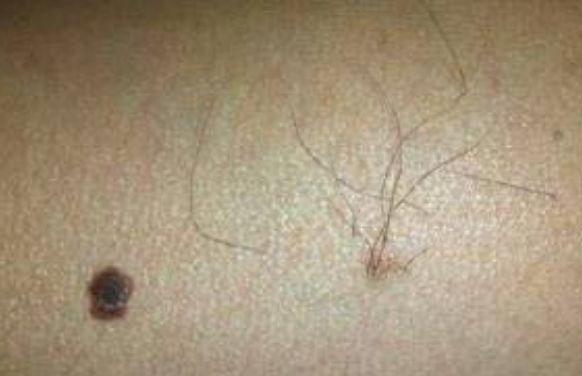 黑痣上长毛可以激光去除吗,黑痣上长毛是好痣还是坏痣