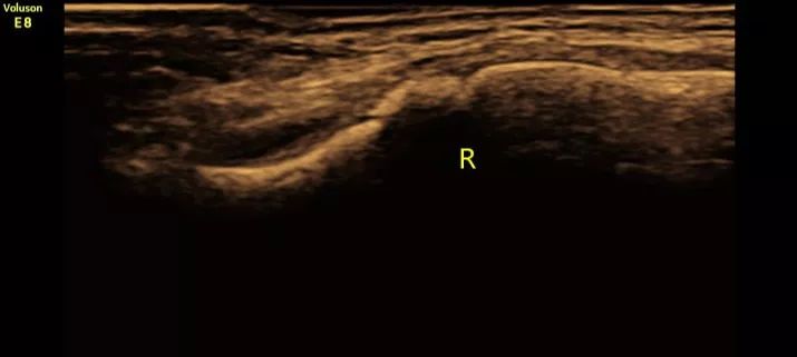 八个月大宝宝锁骨断了,新生儿锁骨断了错位