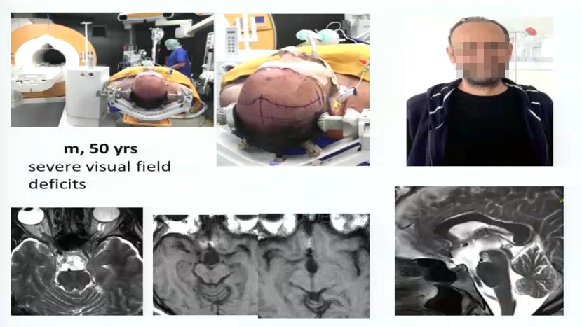 INC巴特朗菲教授视频|视神经-下丘脑胶质瘤全切案例集及治疗解读