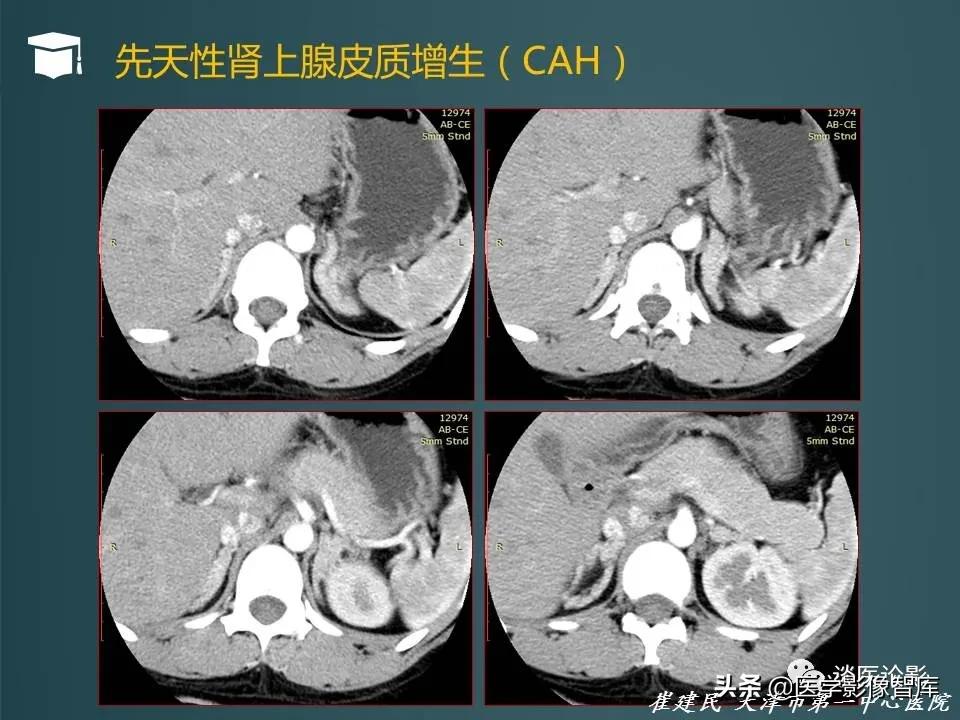 左侧肾上腺结节考虑腺瘤与增生,双侧肾上腺增生是什么原因造成的