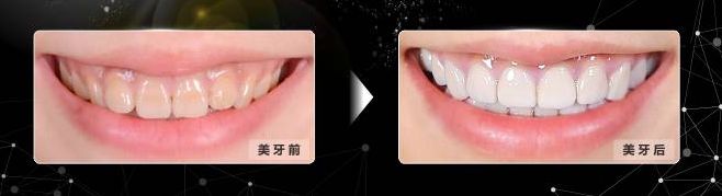 国家有关于牙齿的补贴吗,牙齿补贴报销政策