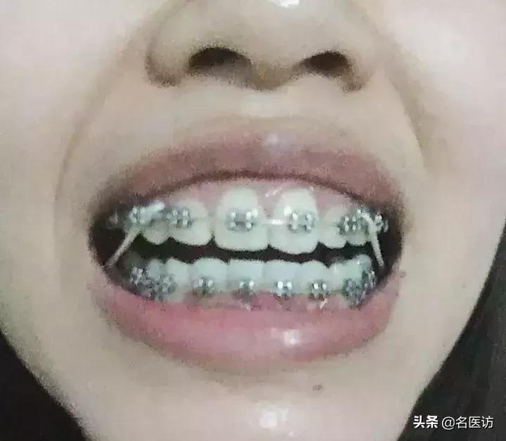 矫正牙齿后牙掉了,矫正牙齿只拔上面2颗牙