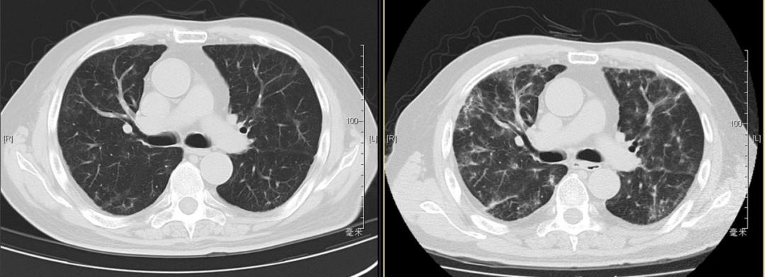 阵发性房颤和用药有关系吗,房颤药物控制好了还会复发吗