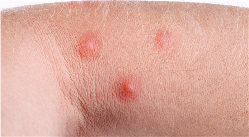 怎么减少挠痒的痒感,夏季过敏性皮炎痒了能挠吗