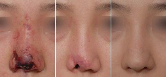 脸部微整形的危害,脸部微整形有什么危害