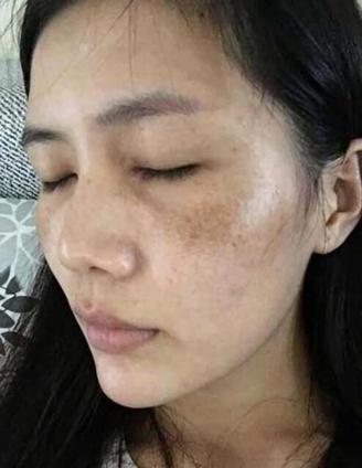 太久不洗澡黑色素沉淀怎么办,突然出现褐斑怎么回事