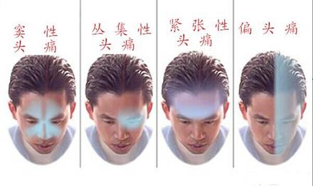 丛集性偏头痛能手术治疗吗,丛集性头痛和神经性头痛哪个严重