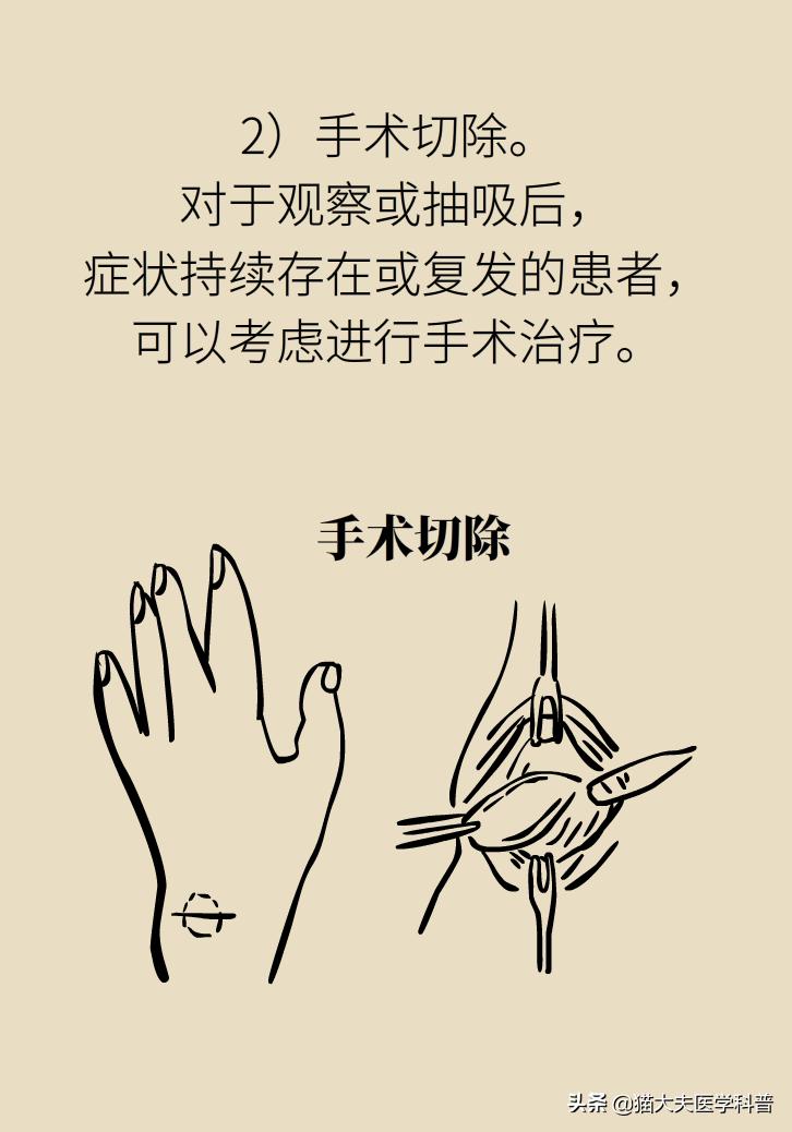 手腕长腱鞘囊肿,手腕上有个凸起的包腱鞘囊肿