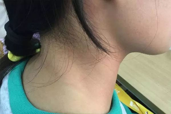 在生活中如何有效预防甲状腺疾病,甲状腺功能减退症的症状表现护理