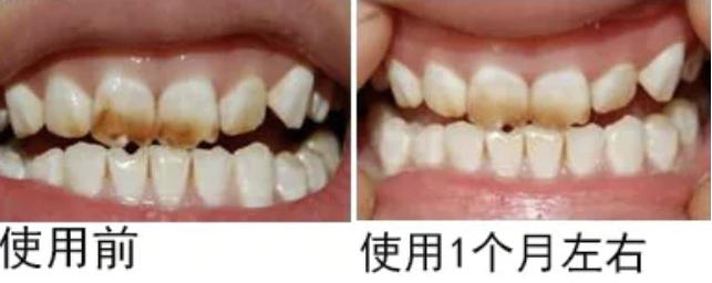 花1000块洗牙美白，效果输给一支烟民牙膏！新西兰人用它白了97年