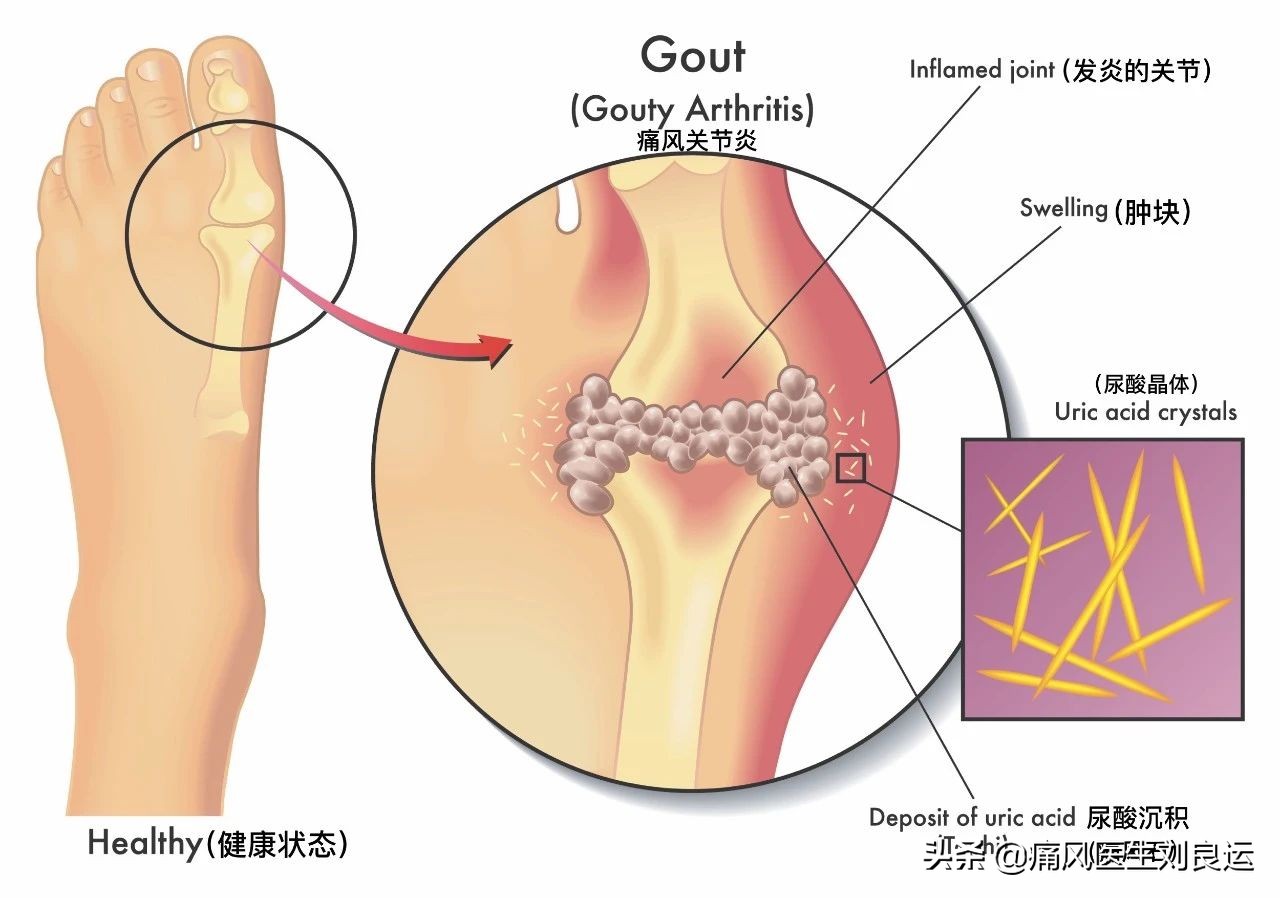尿酸高吃什么药可降尿酸不伤肝,痛风吃什么降尿酸的药不伤肝