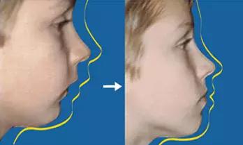 mrc矫正器小孩子晚上不愿意咬,mrc儿童牙齿矫正
