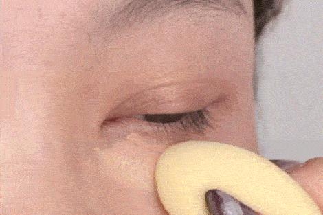 严重泪沟黑眼圈,淡化黑眼圈和泪沟原理