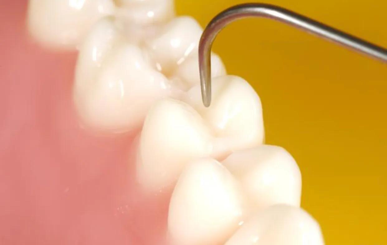 真正超声波牙刷洁牙器,超声波洁牙器是智商税吗