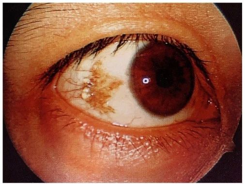 眼睛起了大水泡,我眼睛里面长了一个水泡