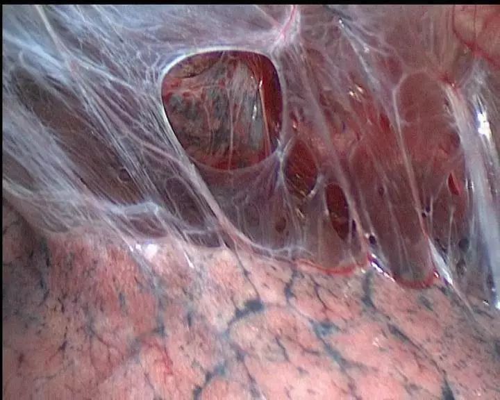 早期肺癌手术半年还是不舒服,早期肺癌手术三年了无化疗