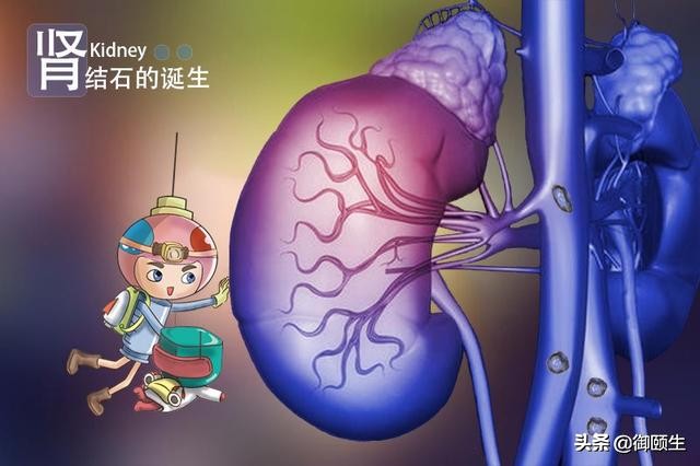 肾结石碎石后会引起肾衰竭吗,肾结石最终导致肾衰的概率大吗