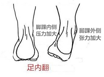 足内翻和踮脚走怎么康复,足内翻会导致什么腿型怎么改