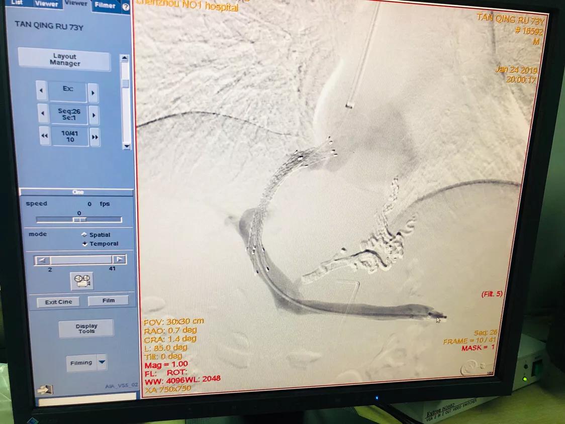 中医治疗肝硬化消化道出血,出奇制胜完整版