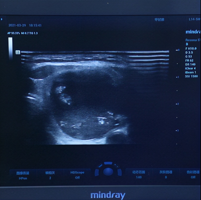 用了激素一个月后脸肿了,化妆品用了一个星期后过敏