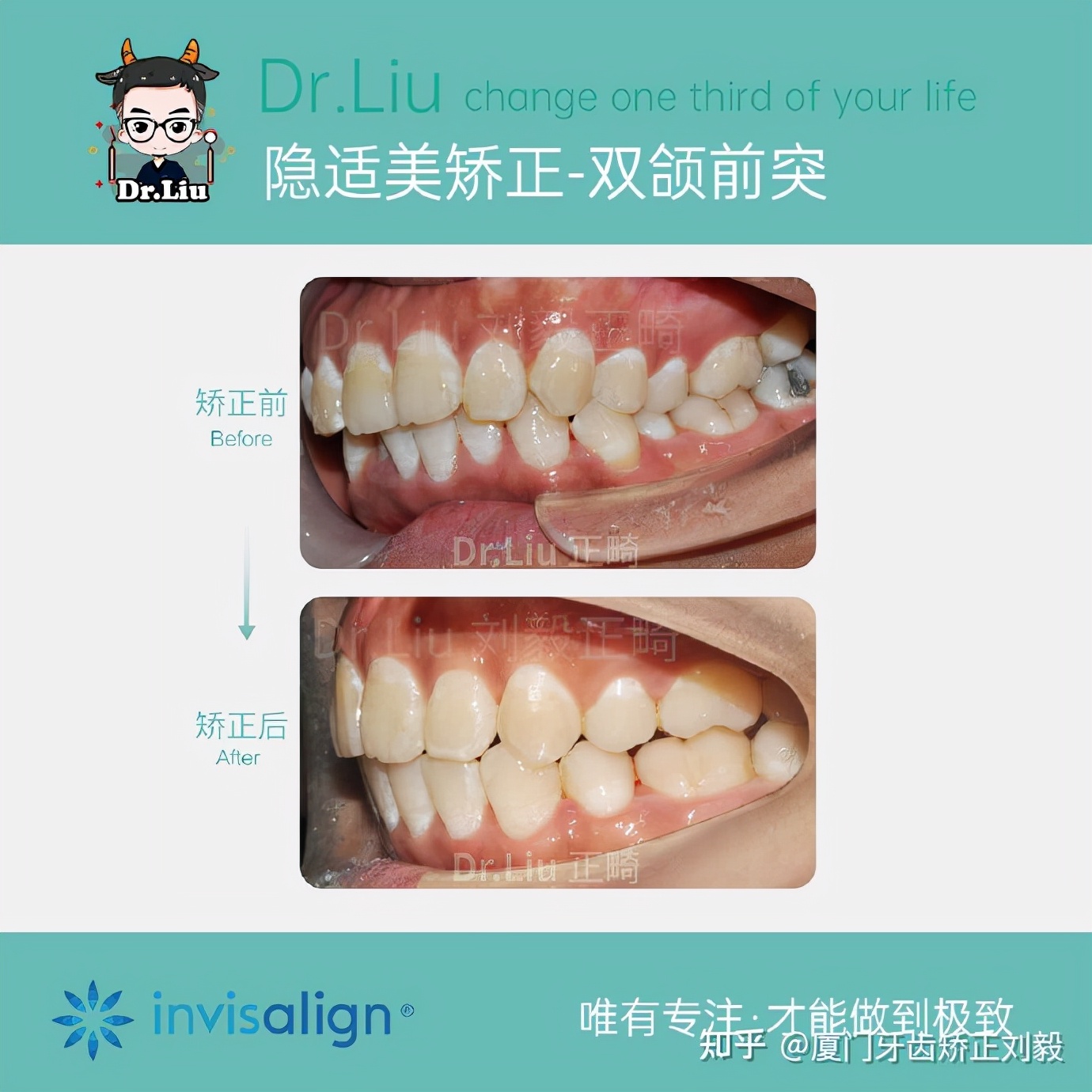 下嘴唇厚且外翻牙齿矫正,深覆合牙齿矫正嘴凸