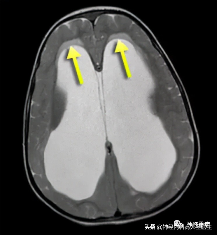 脑水肿是怎么形成,脑水肿和肾水肿的形成机制