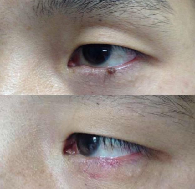 黑色素痣用激光还是手术,痣是手术切除好还是激光好