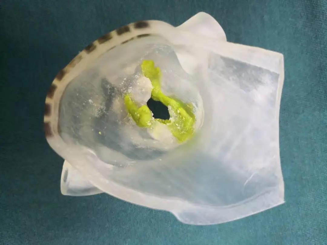 tavr手术华西医院首例,tavr手术国内第一