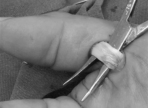 手指狭窄性腱鞘炎挂号去什么科,手指腱鞘炎按痛处吱吱响