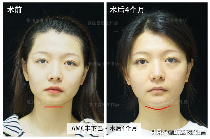下巴缩短整容女,下巴短小北京