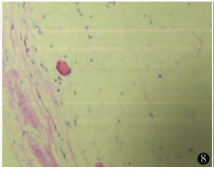 开腹腔切除肿瘤有危险吗 (腹腔内肿瘤割了又长)