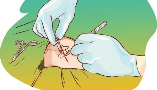 关节置换术后伤口肿胀原因,全髋关节置换五个月了怎么刀口痛