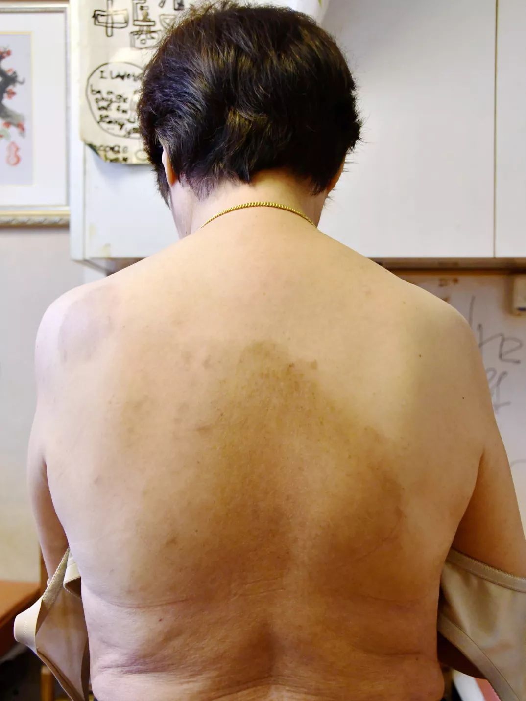 皮炎吃什么中成药能彻底根治,中医治疗皮炎一个疗程是多久