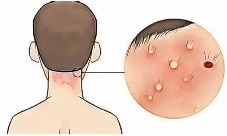 疙瘩一样的毛囊炎反复发作,毛囊炎凸起硬疙瘩跟痤疮的区别