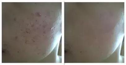 熬夜追《知否》后脸上狂暴痘？这些德国产品可以拯救你的脸！