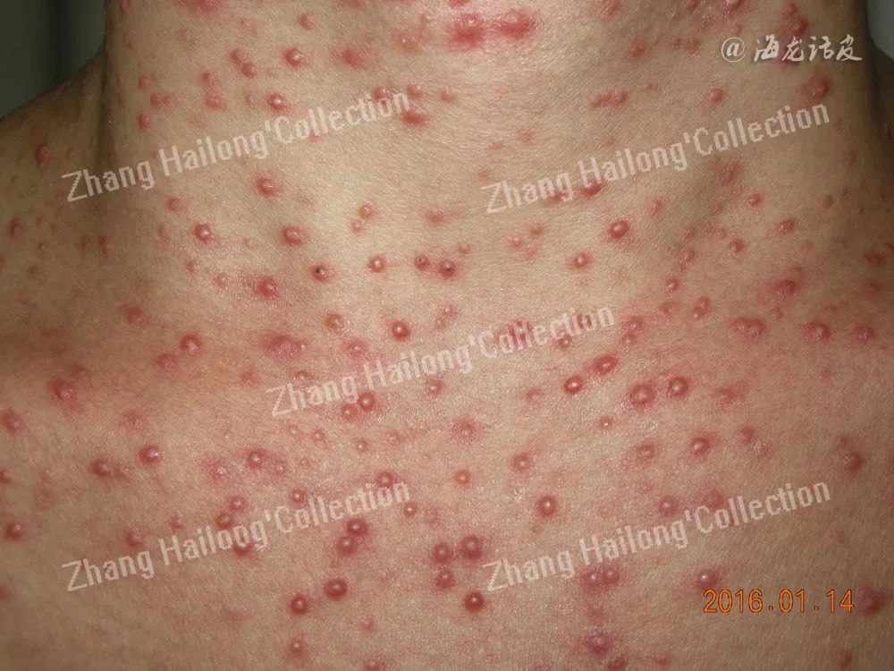 胸口长马拉色菌毛囊炎,前胸后背长满马拉色菌毛囊炎