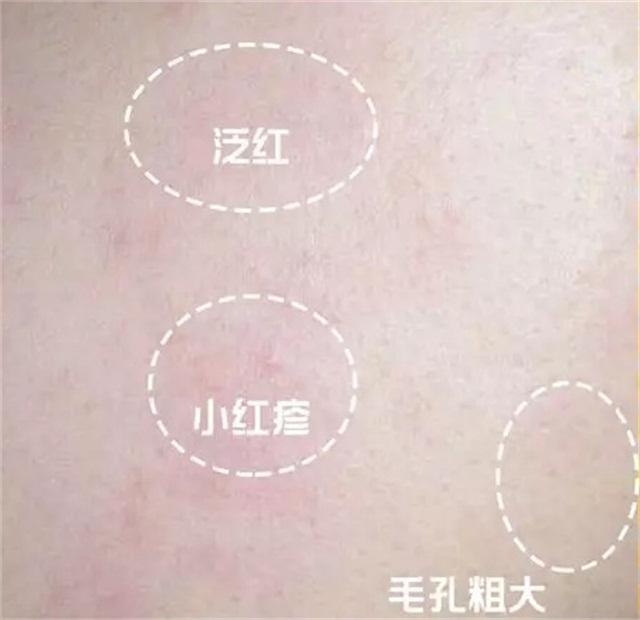 治疗激素脸敏感肌肤,激素脸屏障修护分享