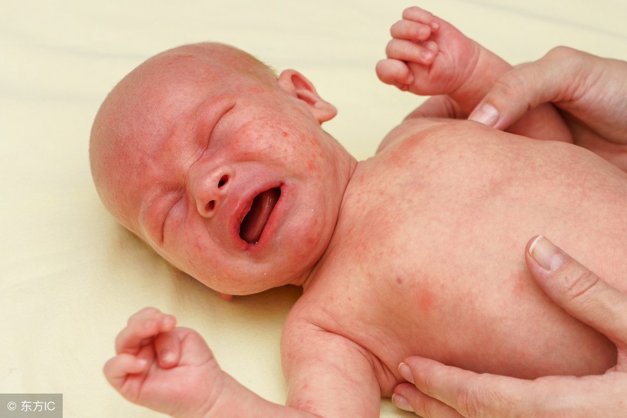 怕宝宝冷得湿疹,防止宝宝湿疹的药