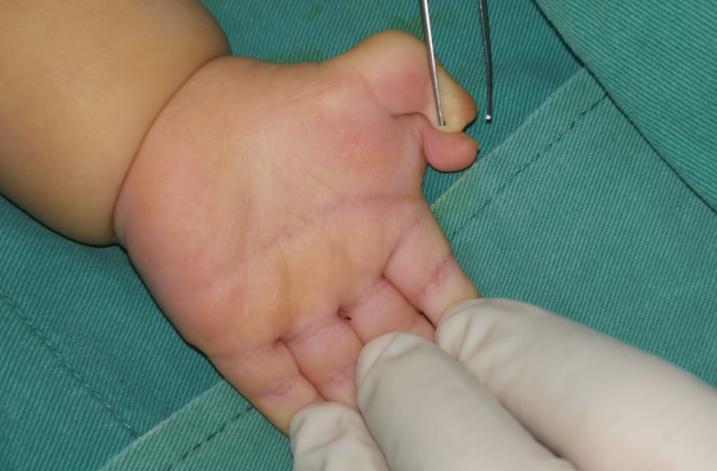 拇指多指手术后怎么护理,拇指漂浮指治疗康复案例