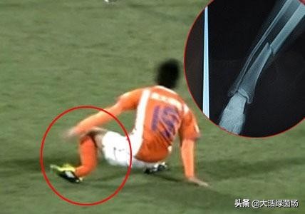 张驰断腿视频完整版,断腿张驰