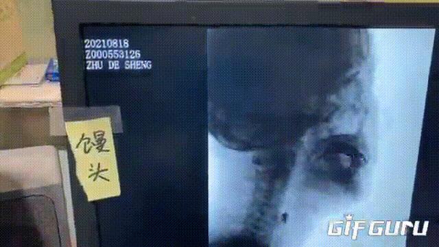 青岛62岁大爷咽不下饭，竟是颈椎骨上长了个“鸟嘴”