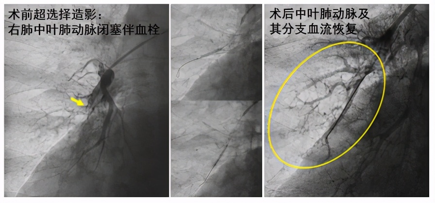 86岁老人呼吸衰竭能自愈吗,86岁肺栓塞怎么治疗