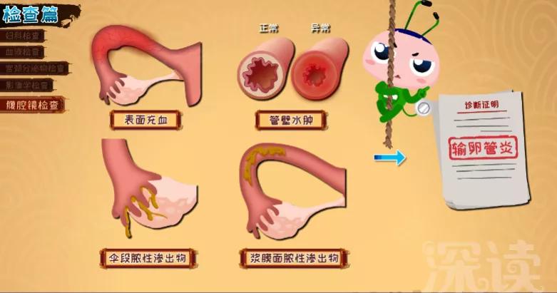 输卵管炎有把握治好吗,严重的输卵管炎要治疗吗