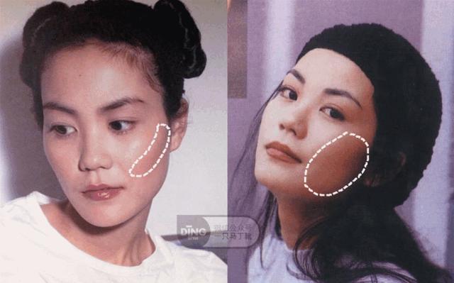 凹面型侧脸怎么改善,凹面型侧脸是怎么造成的