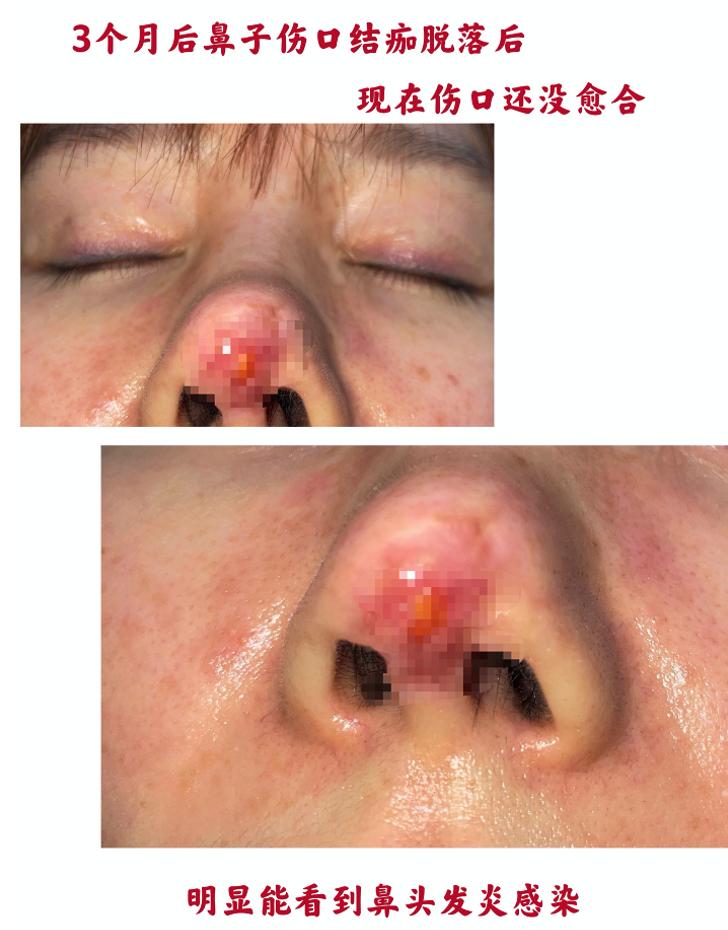 24岁女星整形遇毁容，前途尽毁面临200万赔偿，抑郁险自杀