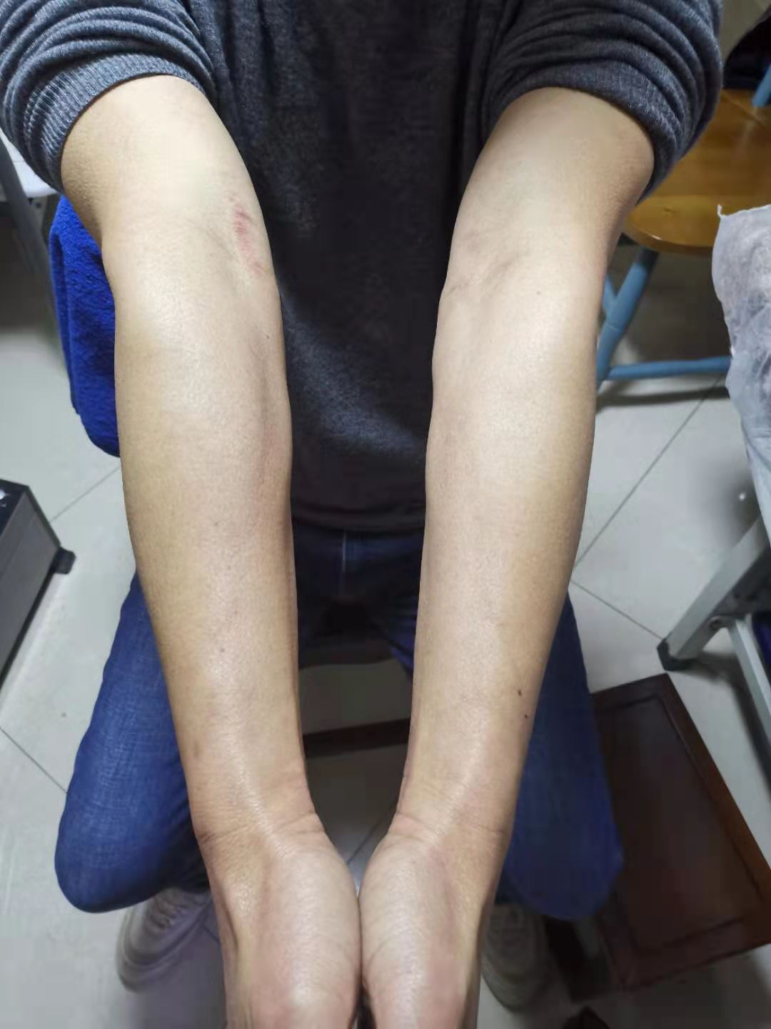 肘关节伸不直推拿正骨手法,李德明柔性正骨肘关节